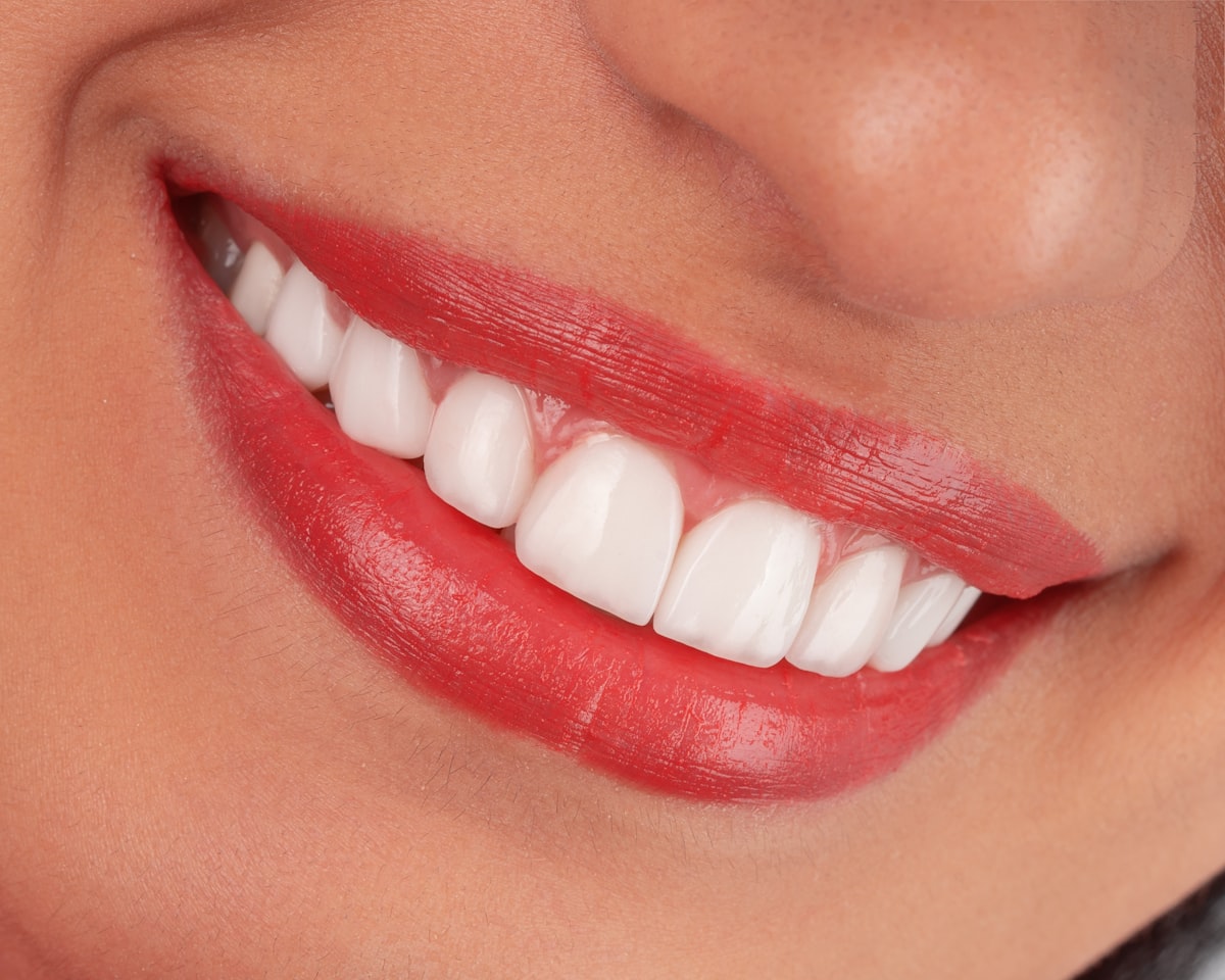 Blanqueamiento dental CABA - OdontologíaMD