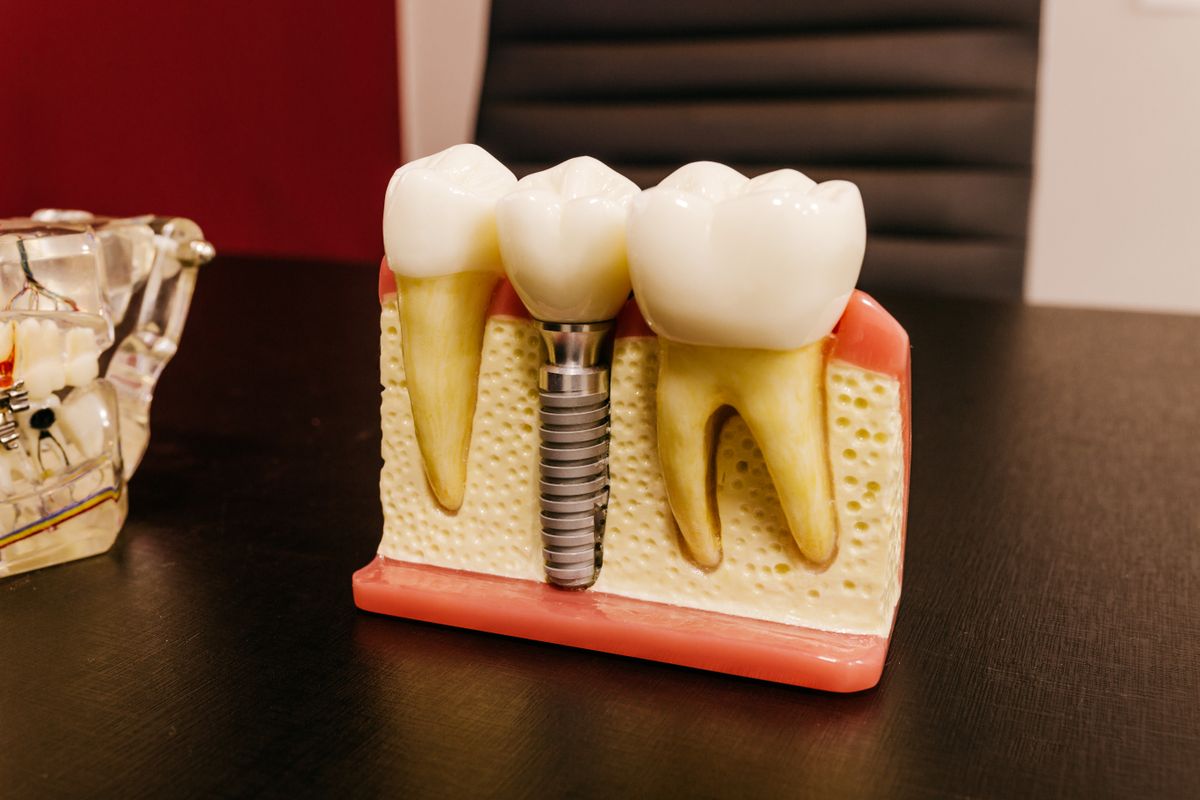 Modelo anatómico de implante dental con tornillo de titanio - OdontologíaMD